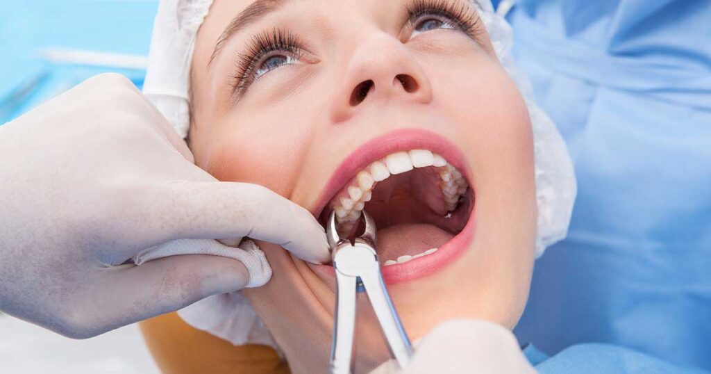 A close-up of a patient in a dental chair during a tooth extraction, with a dentist using forceps to remove a tooth.