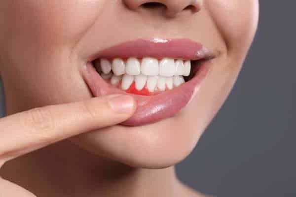 A close-up of a person lifting their lip to reveal red, inflamed gums, indicating symptoms of periodontal disease.