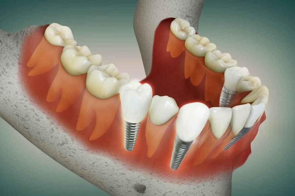 Illustration showing jawbone with missing teeth and dental implants placed