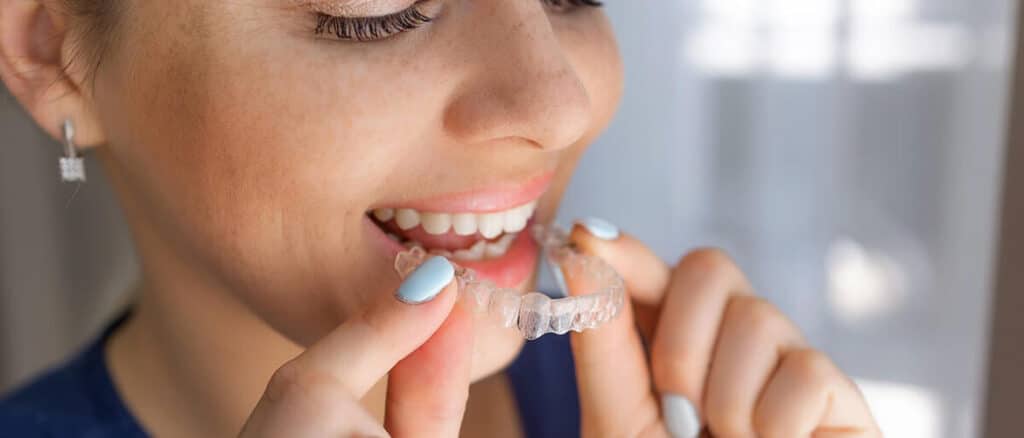 Woman placing clear Invisalign aligner tray on teeth during orthodontic treatment