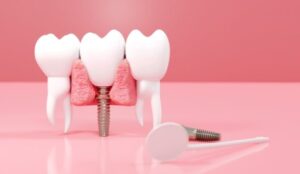 Read more about the article Dental Implants and Gum Health: Why Healthy Gums Matter More Than You Think